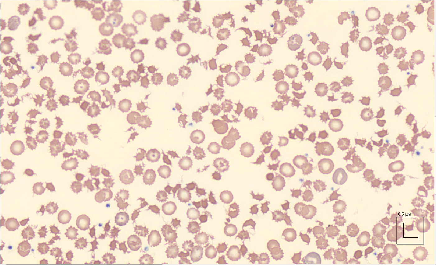 Spur Cell Hemolytic Anemia - Classical hematology