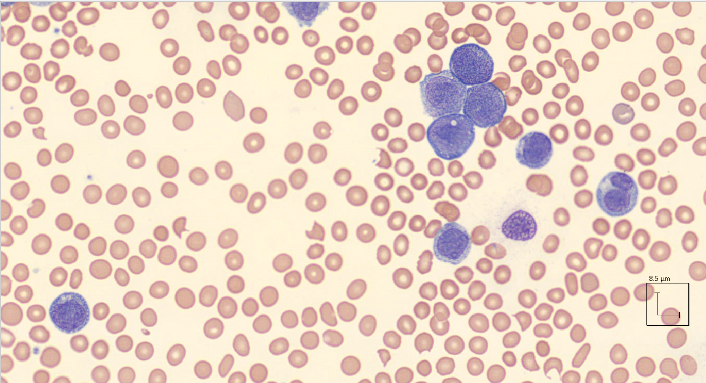 Acute Monocytic Leukemia (AML-M5)