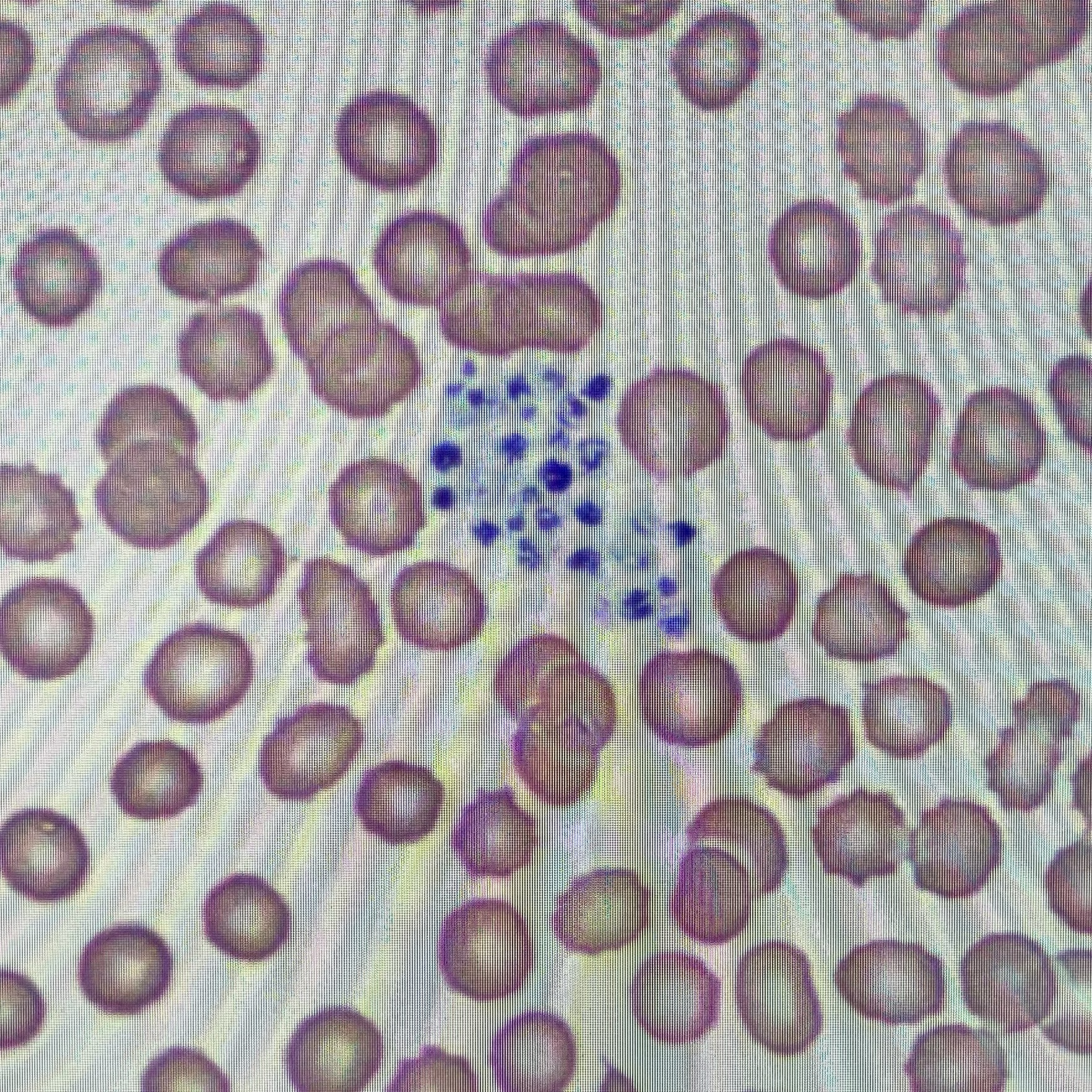 Platelet Clumping (Pseudothrombocytopenia) Question